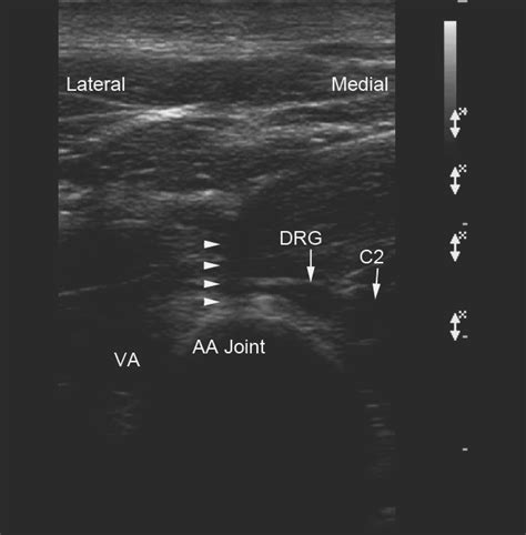 Short Axis Sonogram Showing The Needle Out Of Plane Inside The Download Scientific Diagram