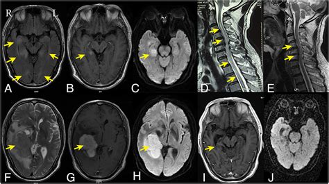 Hodgkins Lymphoma Radiology