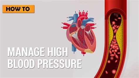 How To Manage High Blood Pressure Youtube