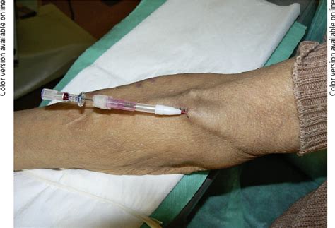 Figure 1 From Use Of Plastic Needles For Early Arteriovenous Fistula