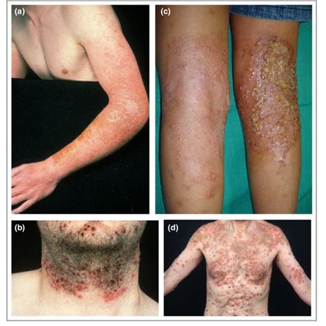 Methicillin Resistant Staphylococcus Aureus Infection In Atopic