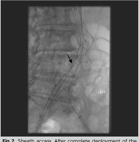 Figure 2 From A Simplified Method Of Pre Emptive Perigraft Aortic Sac