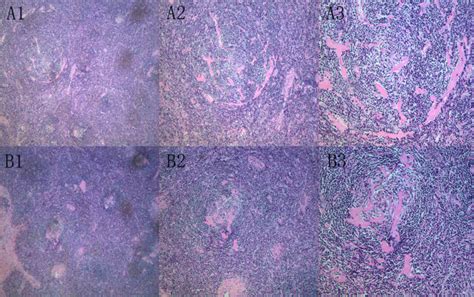 Histological Findings Typical Histologic Features Of Castleman Disease Download Scientific