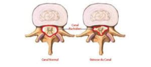 Sténose du Canal Lombaire définitions causes symptomes LesMauxDeDos