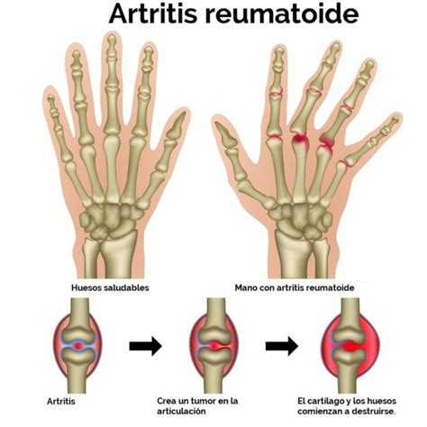 Diferencias Entre Artritis Y Artrosis Cuadros Comparativos Cuadro