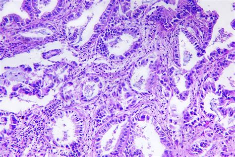 Ad Nocarcinome Intestinal Bien Diff Renci Micrographe L Ger Image