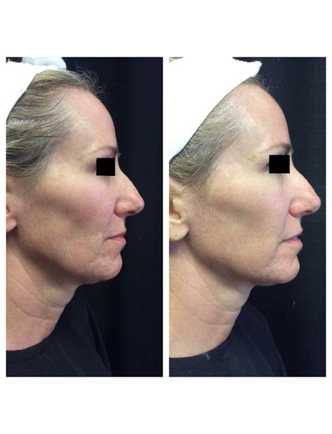 Ultherapy Before And After