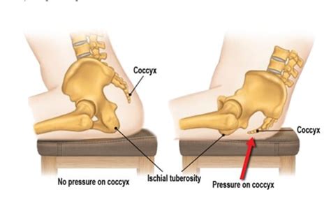 Болит копчик: причины, что делать, лечение боли в области копчика