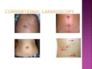 Sils Single Incision Laparoscopic Surgery Ppt