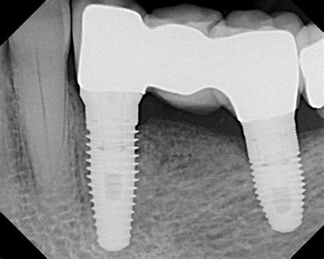 Dental Implant X-rays