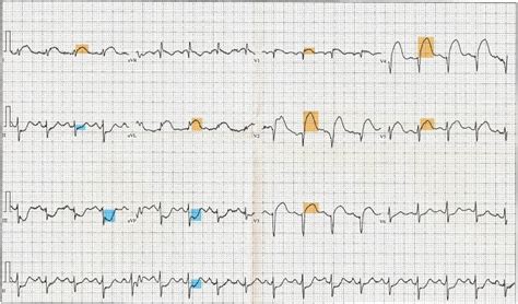 Anterior St Elevation Ecg | Hot Sex Picture