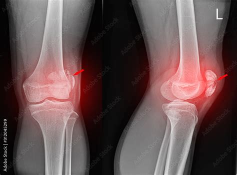 Knee joint x-ray fracture patella. Stock Photo | Adobe Stock