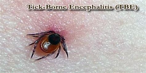 Tick Borne Encephalitis Virus