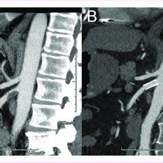 A 50-year-old man presented with postprandial abdominal pain and 13-kg ...