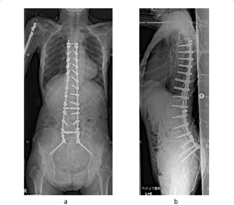 Postoperative X Ray In Supine Position A Anterior Posterior Download Scientific Diagram