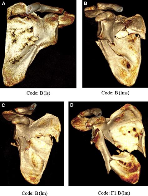 The AO Foundation And Orthopaedic Trauma Association AO OTA Scapula