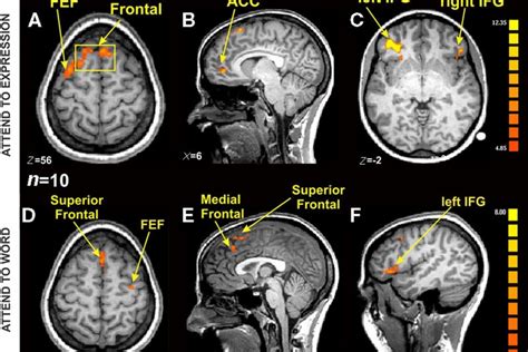 Brain Fmri Scan