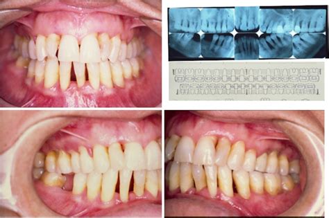 Periodontal Hastalıkları Sınıflaması Ahmet Efeoğlu