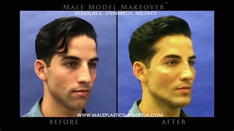 La Male Model Makeover With Facial Filler By Dr Steinbrech 7 Youtube