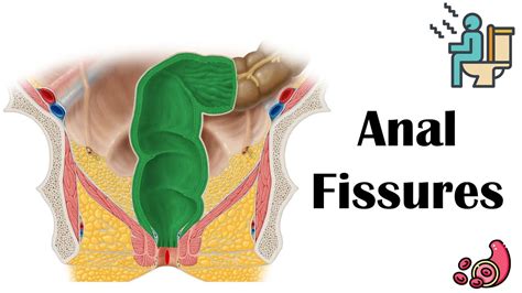 Anal Fissures Causes Risk Factors Pathophysiology Signs And Symptoms