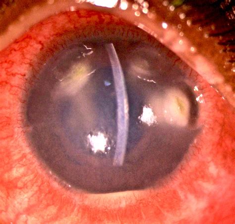 Immune Stromal Keratitis A Rare Ocular Presentation Of Tuberculosis Bmj Case Reports