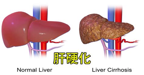 肝若不好，人生是黑白的。如果已有肝炎、肝硬化，這些「飲食守則