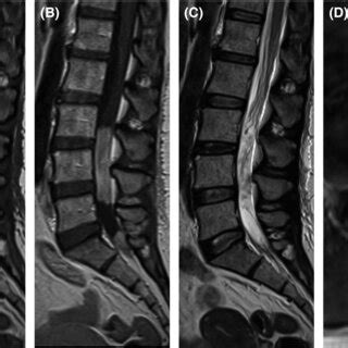 MRI spine, selected images. Sagittal T1 pre‐(A) and post‐(B) contrast ...