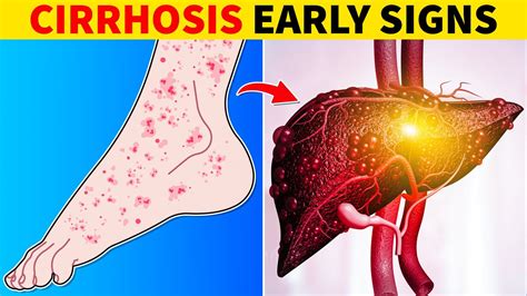 8 Early Signs Of Liver Cirrhosis Youtube