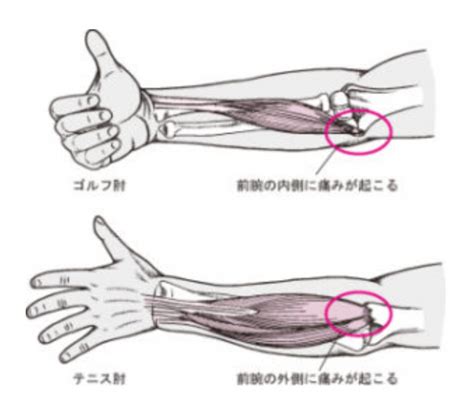 テニス肘、ゴルフ肘とは？ 森の風はり灸接骨院