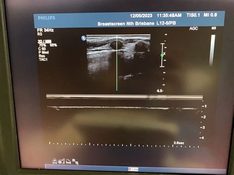 Philips L12 5 50mm Linear Array Ultrasound Transducer Probe Auschoice