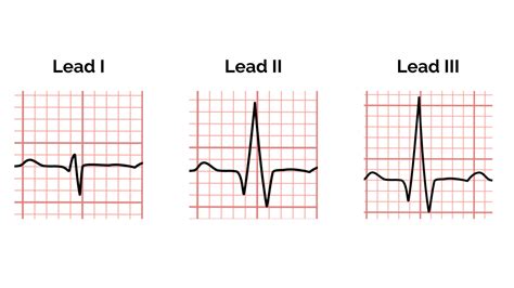 Section Of A Normal Ecg Lead Ii