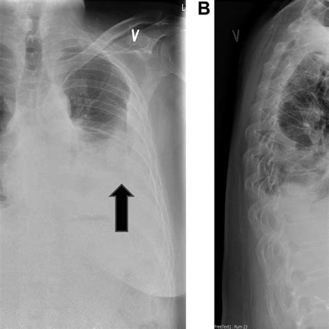 Chest Radiography A Posterior Anterior Projection B Lateral