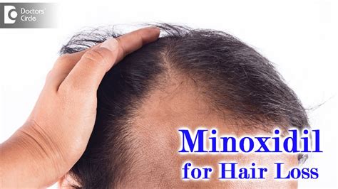 Right Way To Use Minoxidil Solution For Hair Loss Expert Advice Dr