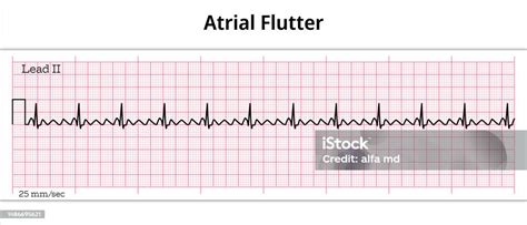 Ecg Atrial Flutter 8 Second Electrocardiogram Paper Stock Illustration