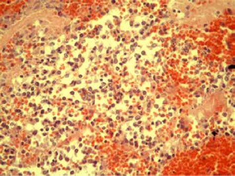 The Microscopic Appearance Of Clear Cell Sarcoma Composed Of Epitheloid