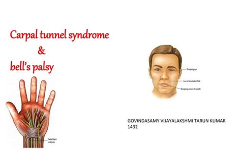 Bells Palsy Ppt