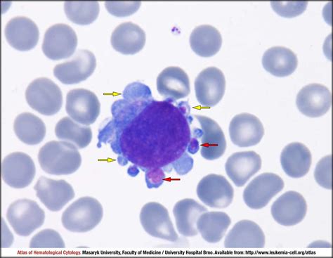 Acute Megakaryoblastic Leukaemia Cell Atlas Of Haematological Cytology