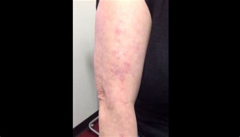 Sun Rash On Arms And Legs