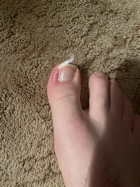 Ingrown Toenail Pulled This Out Of That Hole In My , 53% OFF
