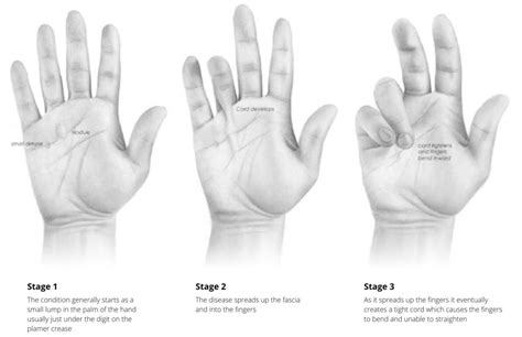 5 Easy Dupuytren's Contracture Exercises for Finger Pain Relief