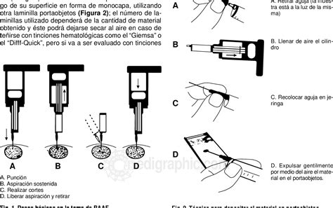 Figure From Biopsia Por Aspiraci N Con Aguja Fina En Lesiones De