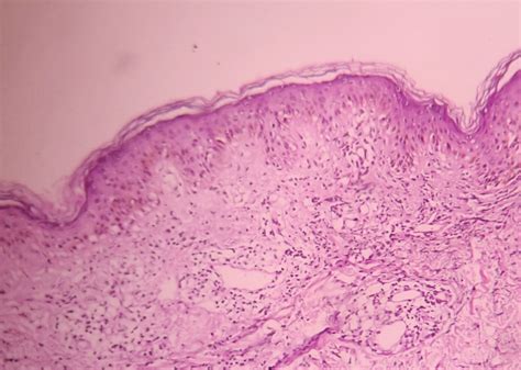 Erythema Gyratum Repens Histology