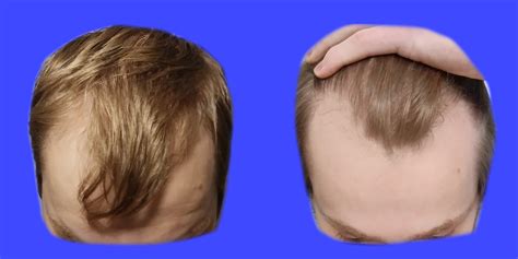 How To Fix Your Thinning Hair Men Only By Austin Meyer Medium