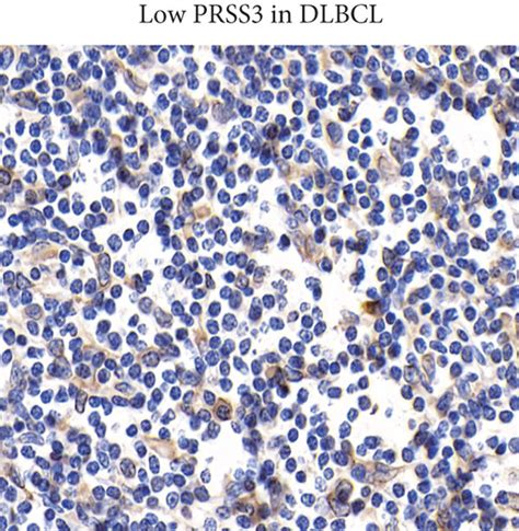 Protein expression of PRSS3 in DLBCL specimens. (a) Representative ...