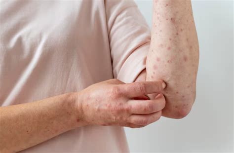 Urticaria Symptoms Causes And Treatment