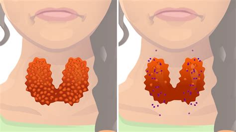 The Different Disorders That Cause Hyperthyroidism - GoodRx