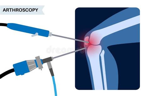 Arthroscopic Joint Stock Illustrations 74 Arthroscopic Joint Stock