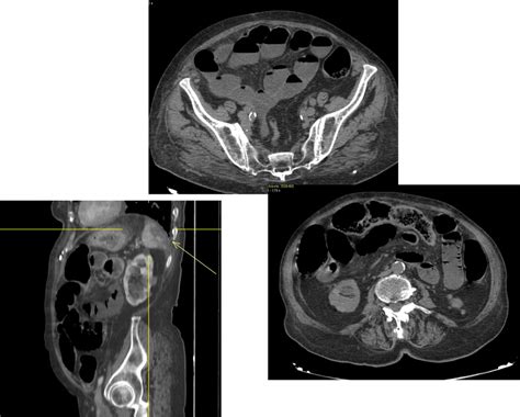 A C Computed Tomography Angiography Of The Abdomen MPR Coronal