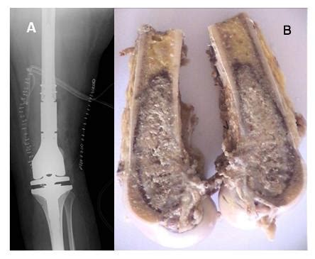 A. Reconstruction with tumour prosthesis of distal femur. Radiological ...