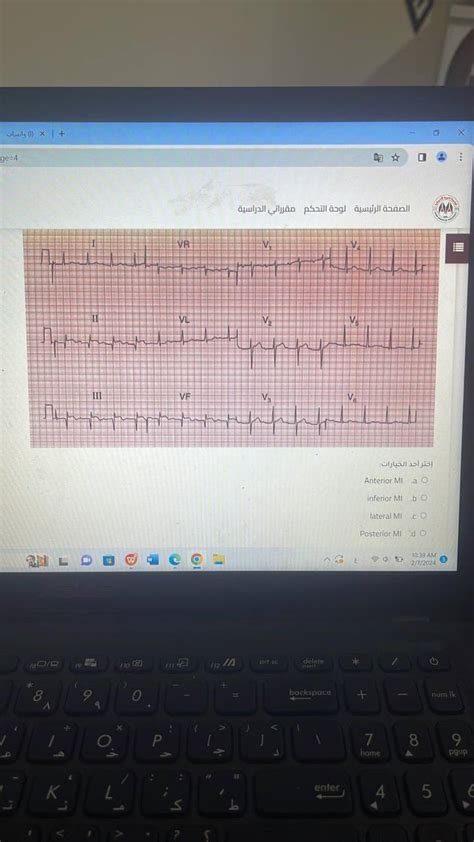 Solved Anterior MI ainferior Mi blateral MIPosterior MI d | Chegg.com